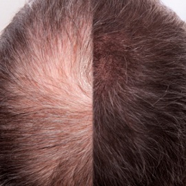 Stymulacja wzrostu włosów za pomocą za pomocą karboksyterapii